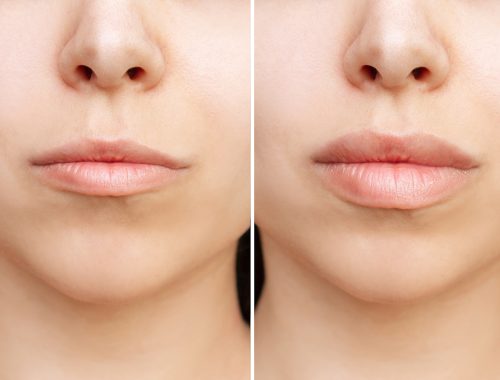 result of lip augmentation. cropped shot of young woman's face w