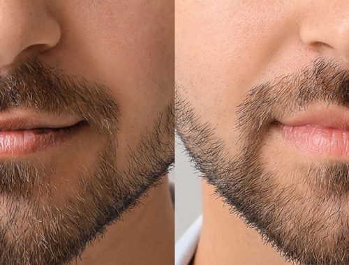 young man before and after lip enhancement, closeup