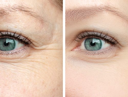 woman face, eye wrinkles before and after treatment the result of rejuvenating cosmetological procedures of biorevitalization, botox and pigment spots removal