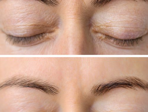 woman's face skin before and after aesthetic beauty cosmetic pro