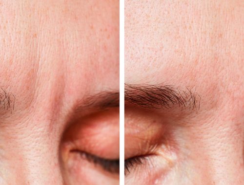 woman before, after a cosmetic procedure, eyebrow wrinkles