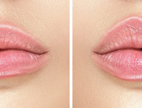 before and after lip filler injections. fillers. lip augmentatio