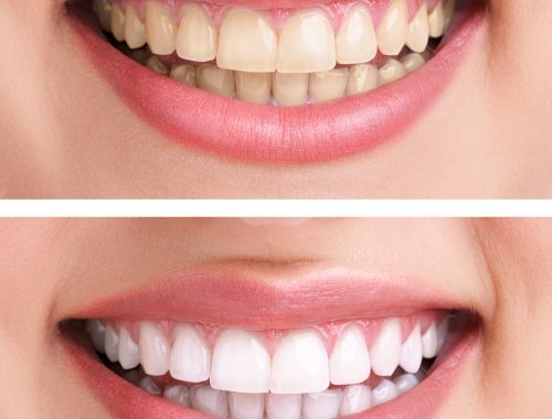 healthy teeth and smile