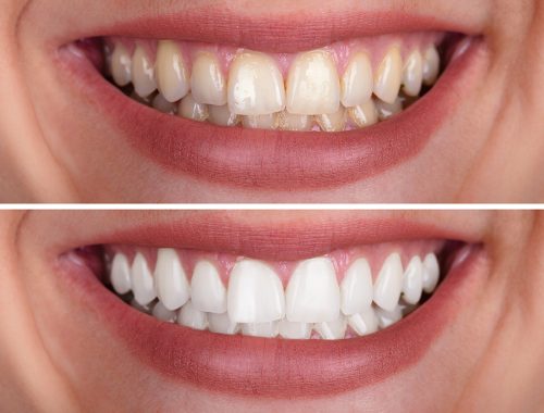 woman's teeth before and after whitening
