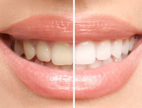 smiling woman before and after teeth whitening procedure, closeu