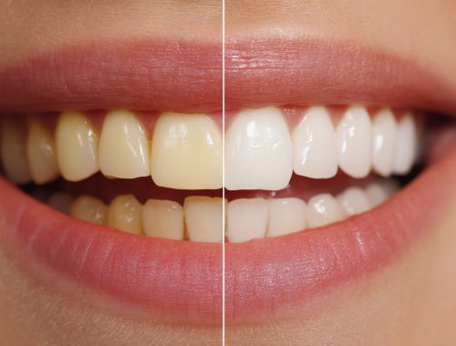 teeth whitening comparison showing yellow and white teeth with p