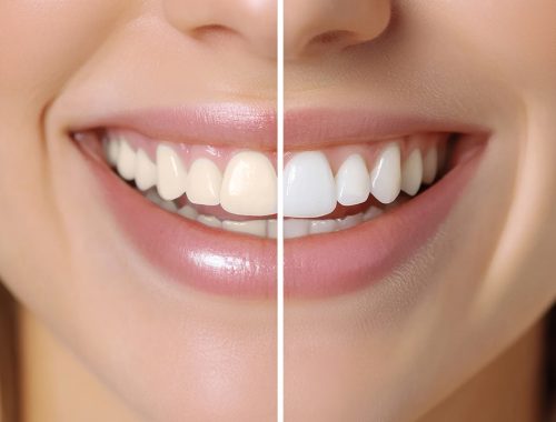 teeth before and after whitening comparison image